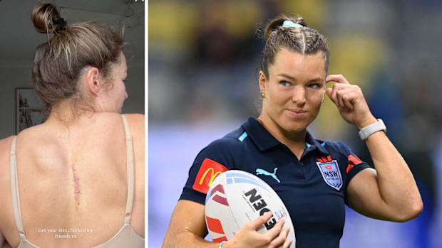 Emma Verran (nee Tonegato) shares an image of the scar on her back.